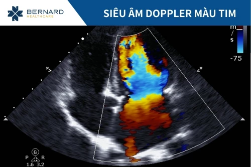 Siêu âm doppler màu tim